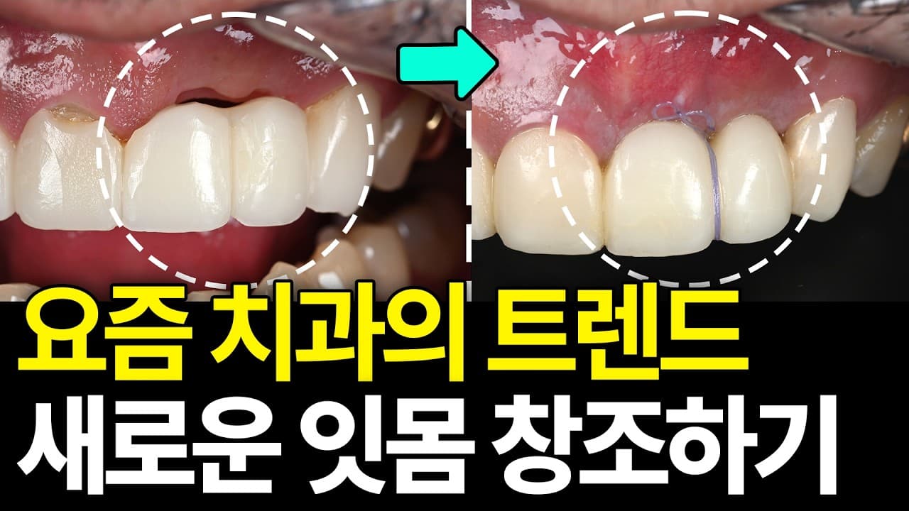 점점 길어지는 치아, 내려앉은 잇몸 되돌릴 수 있을까?