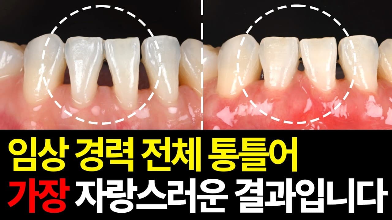 앞니 뺐는데 뼈이식 왜 하나? 뼈 만들기 위해서가 아니다