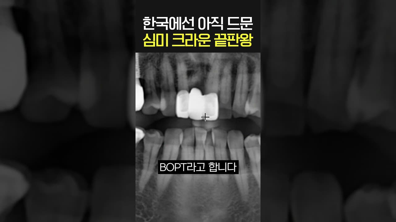 앞니 크라운 씌울 때 치아 경계선 없애면 얻는 이점. 앞니 크라운 치료를 앞두고 잇몸 모양이 어색해질까 봐 걱정하는 환자가 많다.