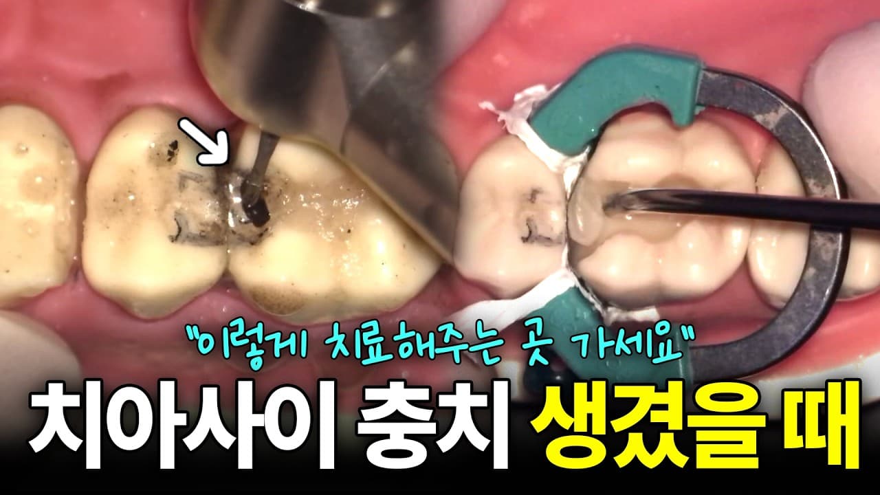 치아 사이 충치, 윗면보다 신경까지 빨리 뚫리는 이유 영상 썸네일