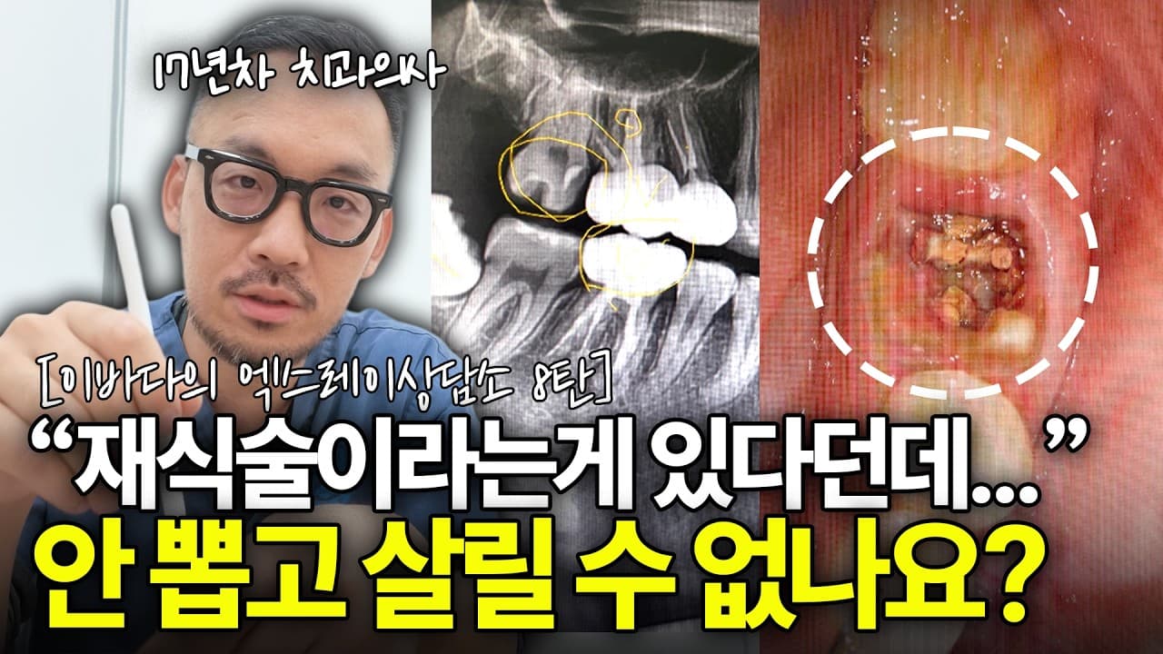 신경치료 한 어금니 계속 아플 때, 빼서 다시 심어도 될까?