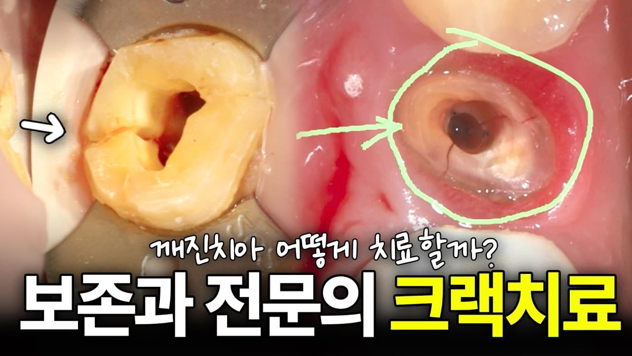 금 간 치아 통증, 무조건 발치하지 않아도 되는 이유 영상 썸네일