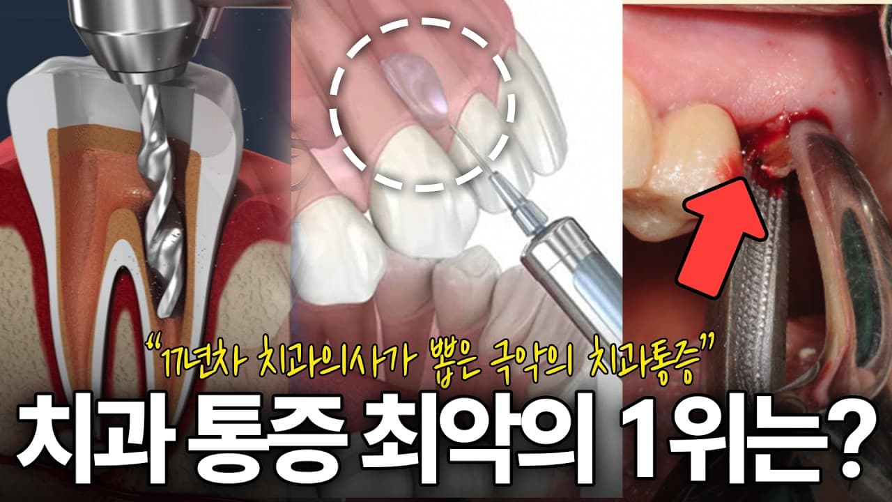 치과에서 가장 아픈 치료, 사랑니 발치 아닌 신경치료