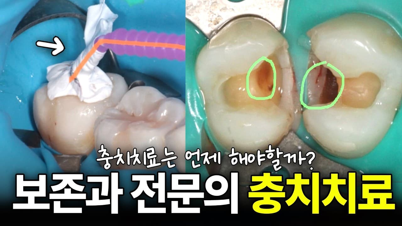 통증 없는 깊은 충치, 놔두면 어느 날 밤잠을 설친다 영상 썸네일